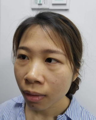 去眼袋手术