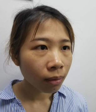 去眼袋手术
