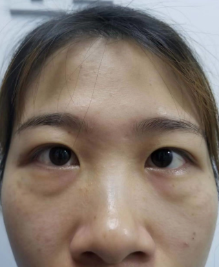 去眼袋手术