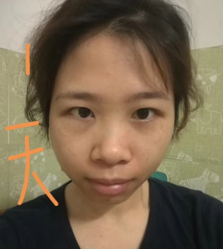 去眼袋手术