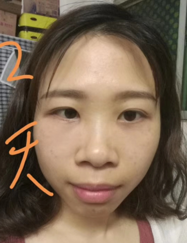 去眼袋手术