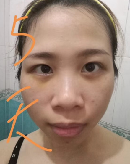 去眼袋手术