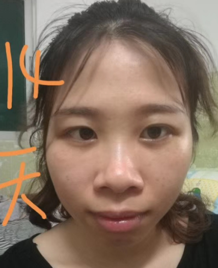 去眼袋手术