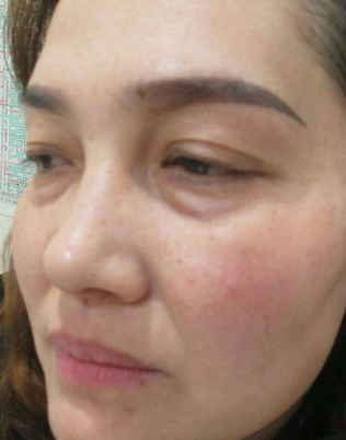 去眼袋手术