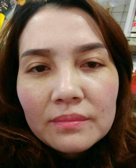 去眼袋手术