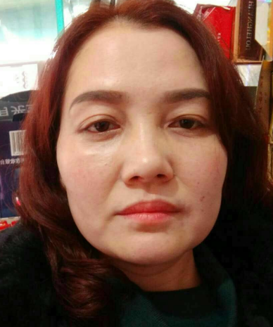 去眼袋手术