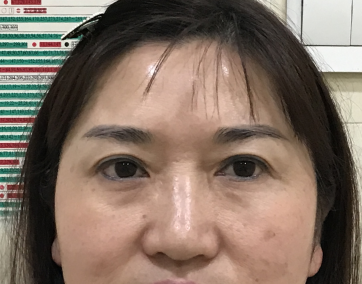 去眼袋手术