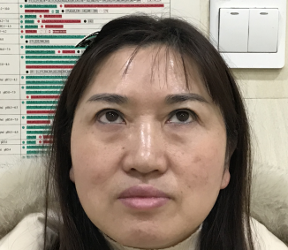 去眼袋手术