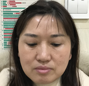 去眼袋手术