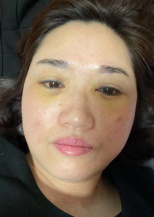 去眼袋手术
