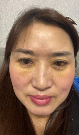 去眼袋手术