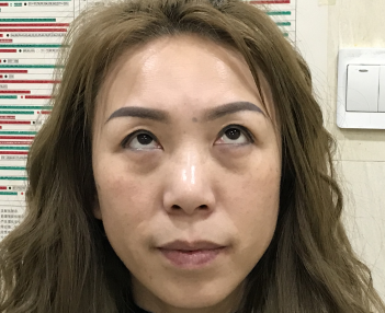 去眼袋手术