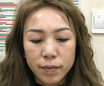 去眼袋手术