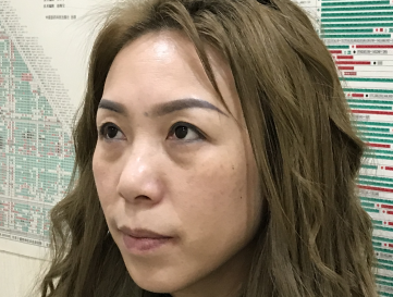去眼袋手术