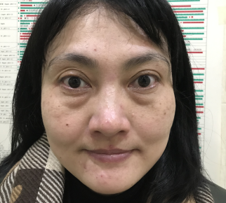 去眼袋手术