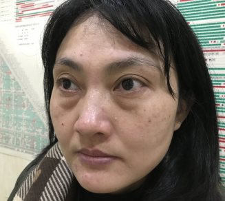去眼袋手术