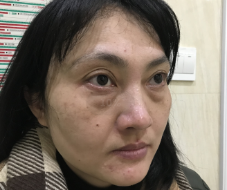 去眼袋手术