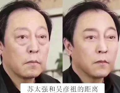 去眼袋手术