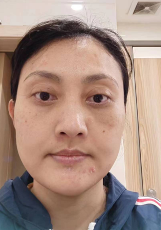 去眼袋手术