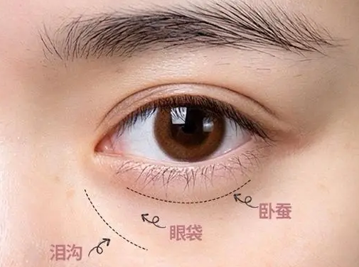 去眼袋手术