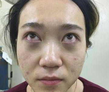 去眼袋手术