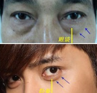 去眼袋手术