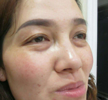 去眼袋手术