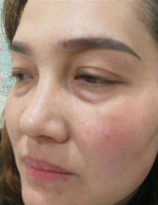 去眼袋手术