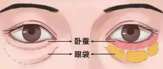 去眼袋手术