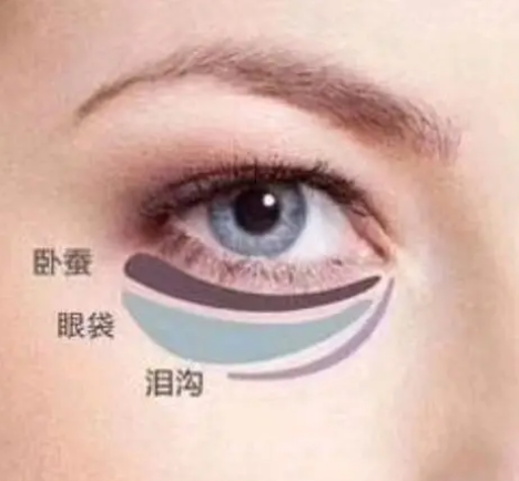 去眼袋手术