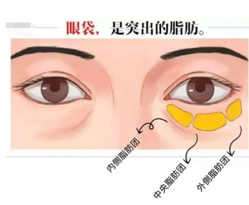去眼袋手术
