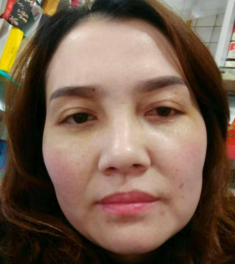 去眼袋手术