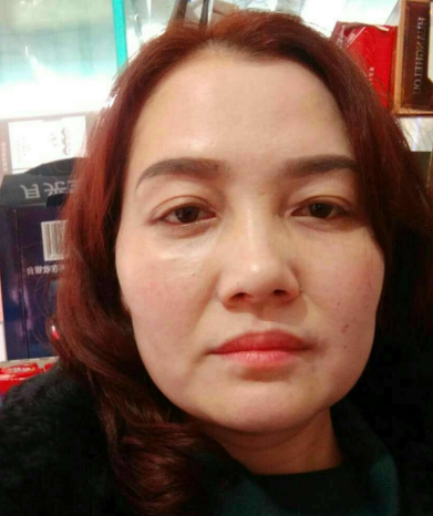 去眼袋手术