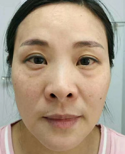 去眼袋手术