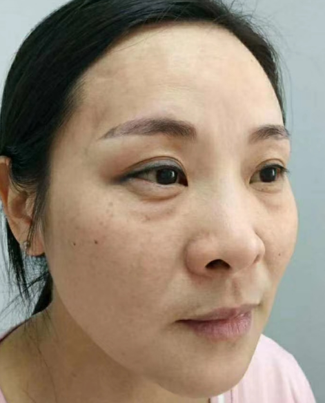 去眼袋手术