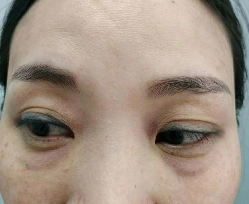 去眼袋手术
