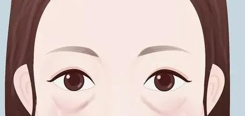 去眼袋手术