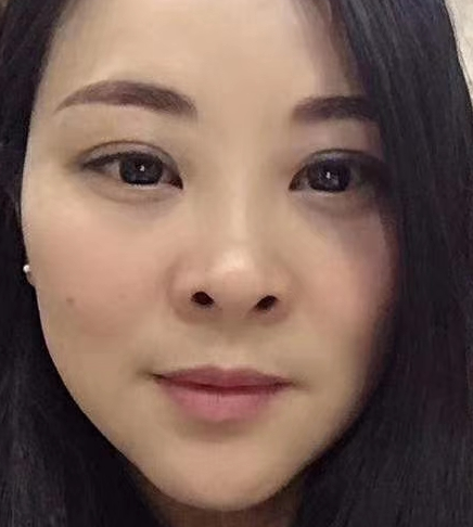 去眼袋手术