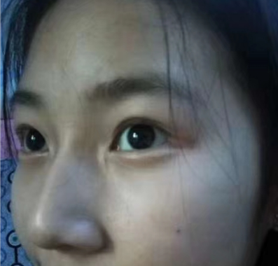 去眼袋手术