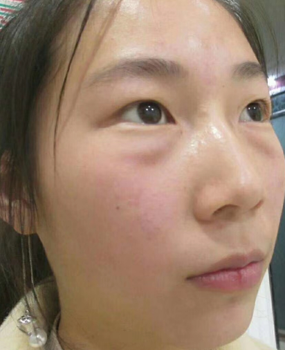去眼袋手术