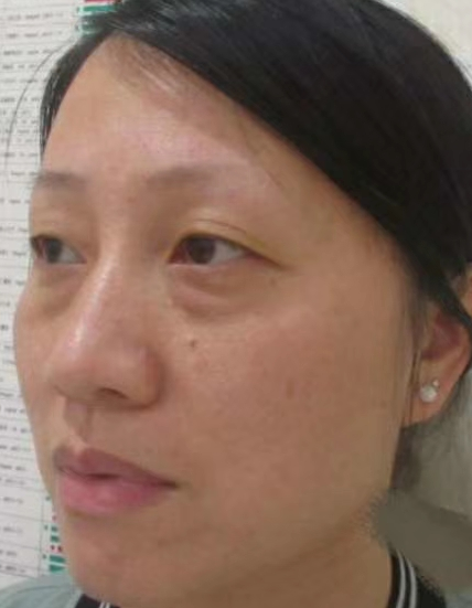去眼袋手术