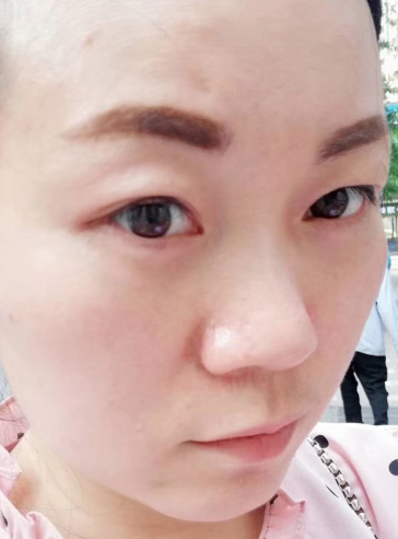 去眼袋手术
