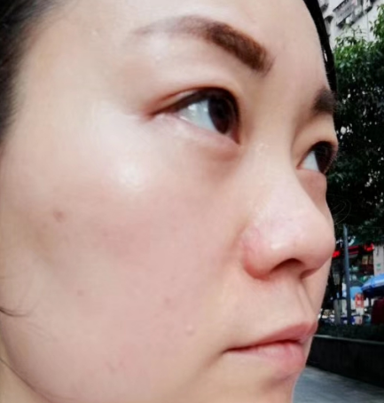 去眼袋手术