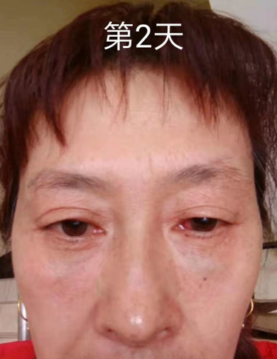 去眼袋手术
