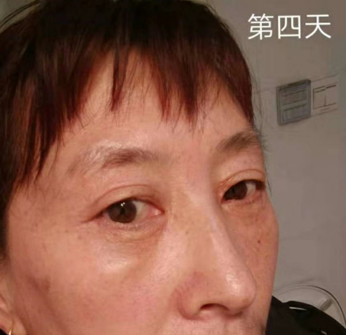 去眼袋手术