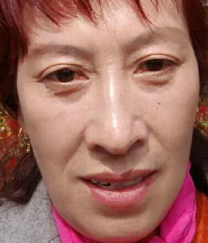 去眼袋手术
