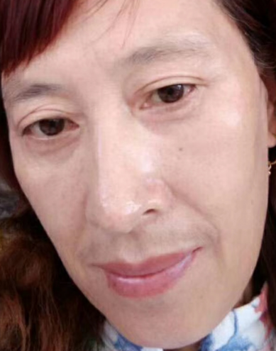 去眼袋手术