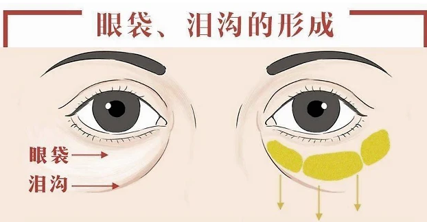 去眼袋手术