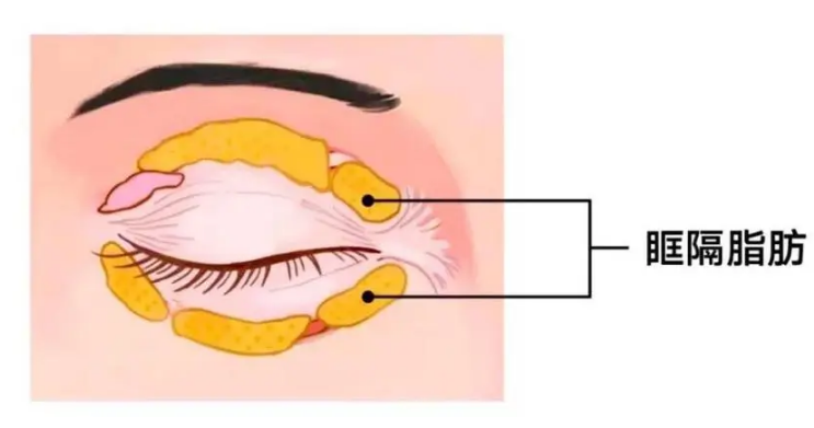 去眼袋手术