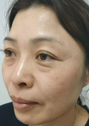 去眼袋手术